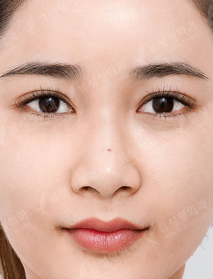 3 Types Facial Contouring + Rhinoplasty — Before