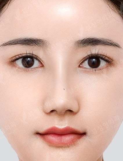 3 Types Facial Contouring + Rhinoplasty — After