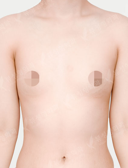 Breast Augmentation (Motiva) (8 Months) — Before