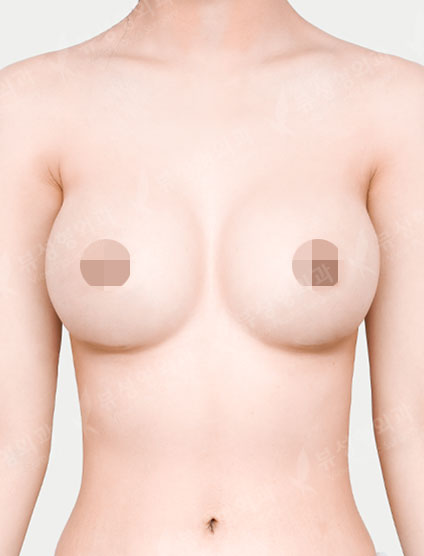 Breast Augmentation (Motiva) (8 Months) — After