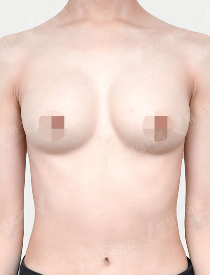 Revisional breast augmentation (Mentor) (8 Months) — Before