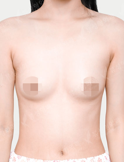 Breast Augmentation (Motiva) (7 Months) — Before