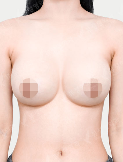 Breast Augmentation (Motiva) (7 Months) — After