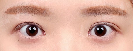 Double Eyelid Revision Surgery (1 Year) — Before