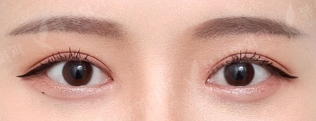 Double Eyelid Revision Surgery (1 Year) — After