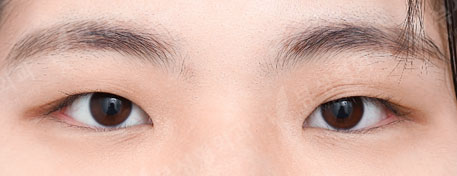 Double Eyelid Surgery + Epicanthoplasty (4 Months) — Before