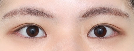 Double Eyelid Surgery + Epicanthoplasty (4 Months) — After