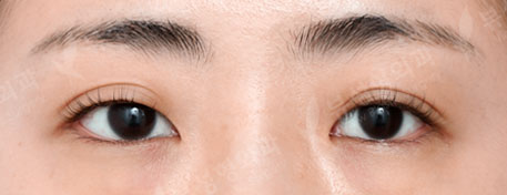 Double Eyelid Surgery + Under Eye Fat Reposition + Epicanthoplasty + Lateral Canthoplasty + Lateral Hotz Canthoplasty (7 Months) — Before