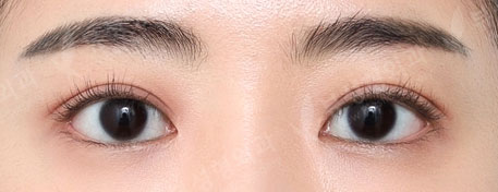 Double Eyelid Surgery + Under Eye Fat Reposition + Epicanthoplasty + Lateral Canthoplasty + Lateral Hotz Canthoplasty (7 Months) — After