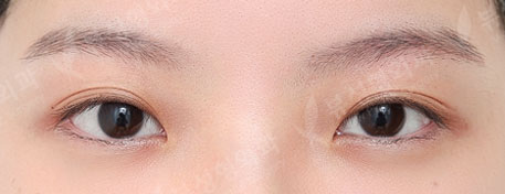 Double Eyelid Surgery + Epicanthoplasty + Lateral Canthoplasty + Lateral Hotz Canthoplasty (3 Months) — Before