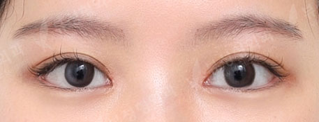 Double Eyelid Surgery + Epicanthoplasty + Lateral Canthoplasty + Lateral Hotz Canthoplasty (3 Months) — After