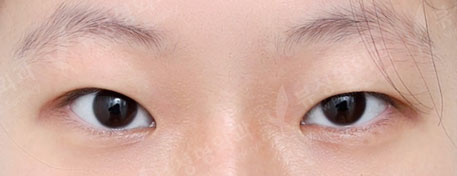 Double Eyelid Surgery + Epicanthoplasty + Lateral Canthoplasty + Lateral Hotz Canthoplasty (3 Months) — Before