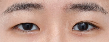 Double Eyelid Surgery + Epicanthoplasty (3 Months) — Before