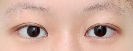 ศัลยกรรมตา + เปิดหัวตา + เปิดหางตา + เปิดใต้ตา (3 Months) — After
