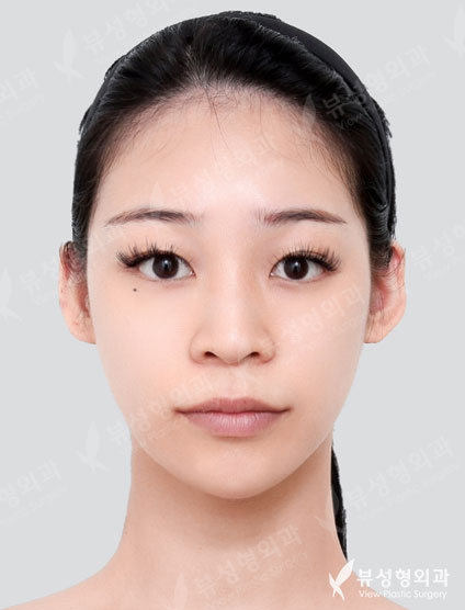 เสริมจมูก (7 Months) — Before