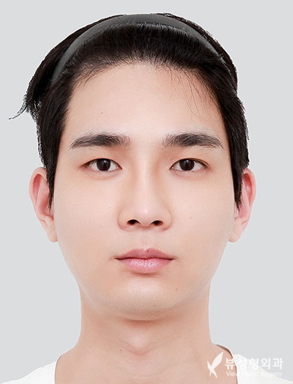 3 Types Facial Contouring + Fat Graft(Smile lines, Cheeks) + weir reduction (4 Months) — Before