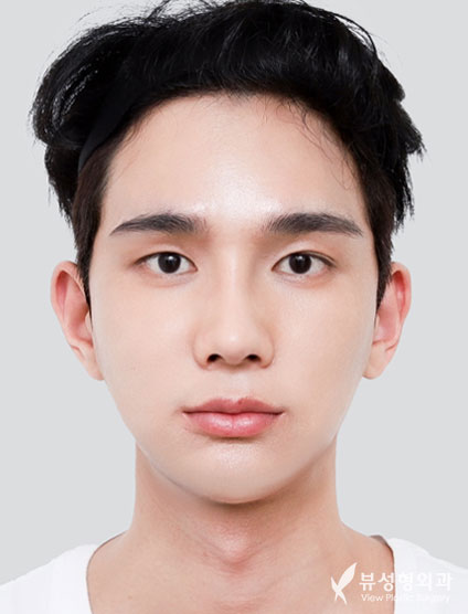3 Types Facial Contouring + Fat Graft(Smile lines, Cheeks) + weir reduction (4 Months) — After