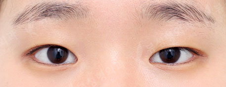 Double Eyelid Surgery + Epicanthoplasty (2 Months) — Before
