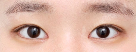 Double Eyelid Surgery + Epicanthoplasty (2 Months) — After