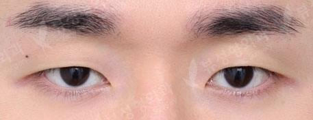 Double Eyelid Surgery (1 Month) — Before