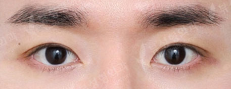 Double Eyelid Surgery (1 Month) — After