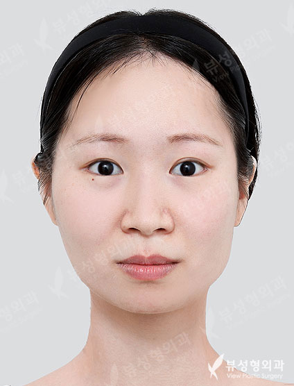 3 Types Facial Contouring + Fat Graft(Smile lines, Forehead, Temples) + Rhinoplasty (5 Months) — Before