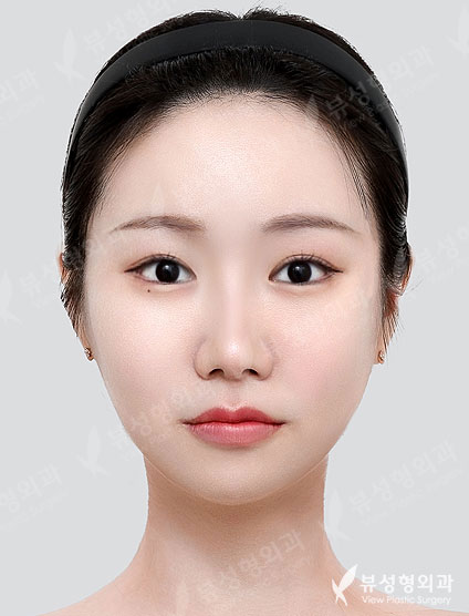 3 Types Facial Contouring + Fat Graft(Smile lines, Forehead, Temples) + Rhinoplasty (5 Months) — After