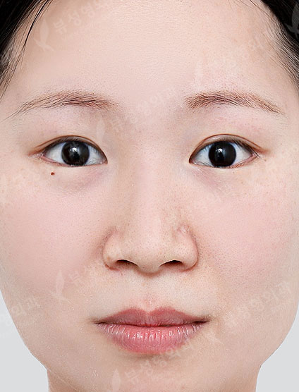 3 Types Facial Contouring + Fat Graft(Smile lines, Forehead, Temples) + Rhinoplasty (5 Months) — Before