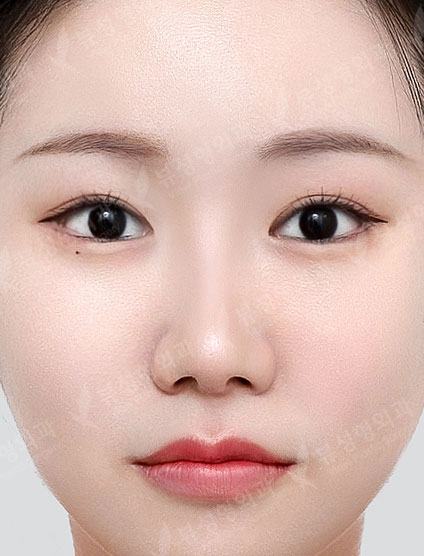 3 Types Facial Contouring + Fat Graft(Smile lines, Forehead, Temples) + Rhinoplasty (5 Months) — After