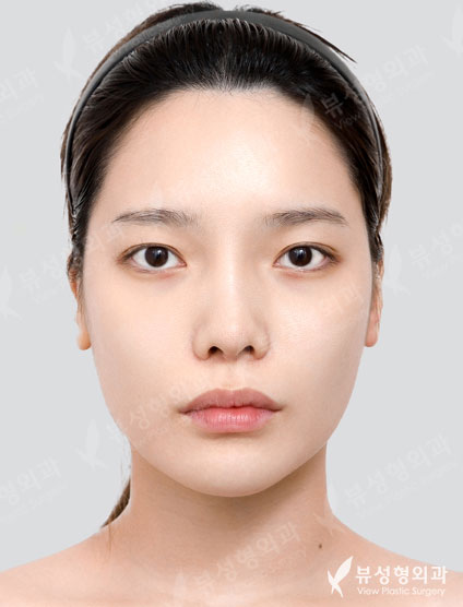 3 Types Facial Contouring + Double Eyelid Surgery + Epicanthoplasty + Revision Rhinoplasty (2 Months) — Before