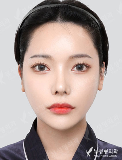 3 Types Facial Contouring + Double Eyelid Surgery + Epicanthoplasty + Revision Rhinoplasty (2 Months) — After