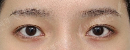 3 Types Facial Contouring + Double Eyelid Surgery + Epicanthoplasty + Revision Rhinoplasty (2 Months) — Before