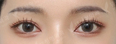 3 Types Facial Contouring + Double Eyelid Surgery + Epicanthoplasty + Revision Rhinoplasty (2 Months) — After