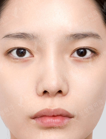 3 Types Facial Contouring + Double Eyelid Surgery + Epicanthoplasty + Revision Rhinoplasty (2 Months) — Before