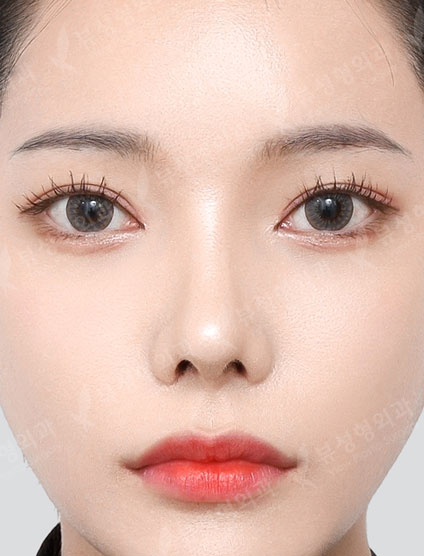 3 Types Facial Contouring + Double Eyelid Surgery + Epicanthoplasty + Revision Rhinoplasty (2 Months) — After