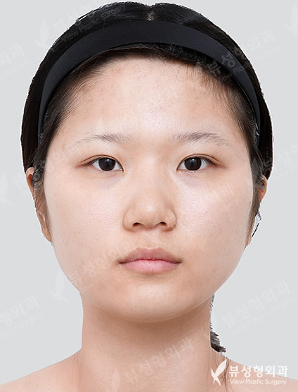 3 Types Facial Contouring + Liposuction + Botox (14 Days) — Before