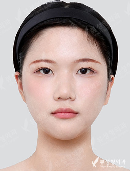 3 Types Facial Contouring + Liposuction + Botox (14 Days) — After