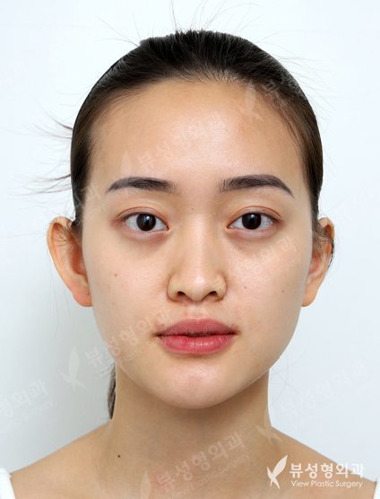 3 Types Facial Contouring + Double Eyelid Surgery + Rhinoplasty (1 Year) — Before