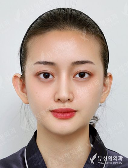 3 Types Facial Contouring + Double Eyelid Surgery + Rhinoplasty (1 Year) — After