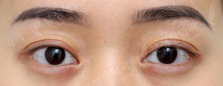 3 Types Facial Contouring + Double Eyelid Surgery + Rhinoplasty (1 Year) — Before