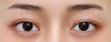 3 Types Facial Contouring + Double Eyelid Surgery + Rhinoplasty (1 Year) — After