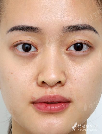 3 Types Facial Contouring + Double Eyelid Surgery + Rhinoplasty (1 Year) — Before