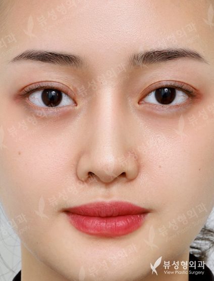 3 Types Facial Contouring + Double Eyelid Surgery + Rhinoplasty (1 Year) — After
