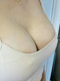 [Breast Augmentation] Kim Jeong-hee