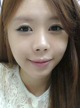 [Natural V line + cheekbone reduction] Park Hyun-young