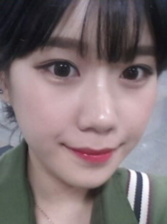 [Natural V line + cheekbone reduction + forehead implant] Dahye Kim