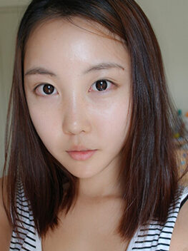 [V-line + cheekbone reduction + T.O.P rhinoplasty (reoperation) + facial fat grafting] Kim Soo-young