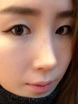 [T.O.P rhinoplasty] Kim Soo-min