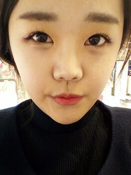 [Nano Yangak + Natural V Line + Cheeks Reduction] Kim Seon-young