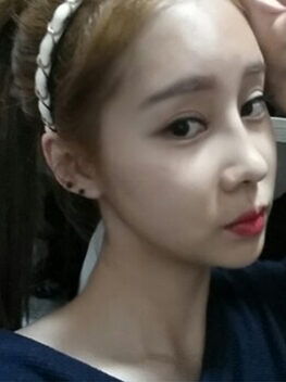 [FACE OFF (nano bimaxillary jaw + doll line + cheekbone reduction) + forehead prosthesis + frontal prosthesis + non-incision eyelid correction + rhinoplasty] Park So-jin